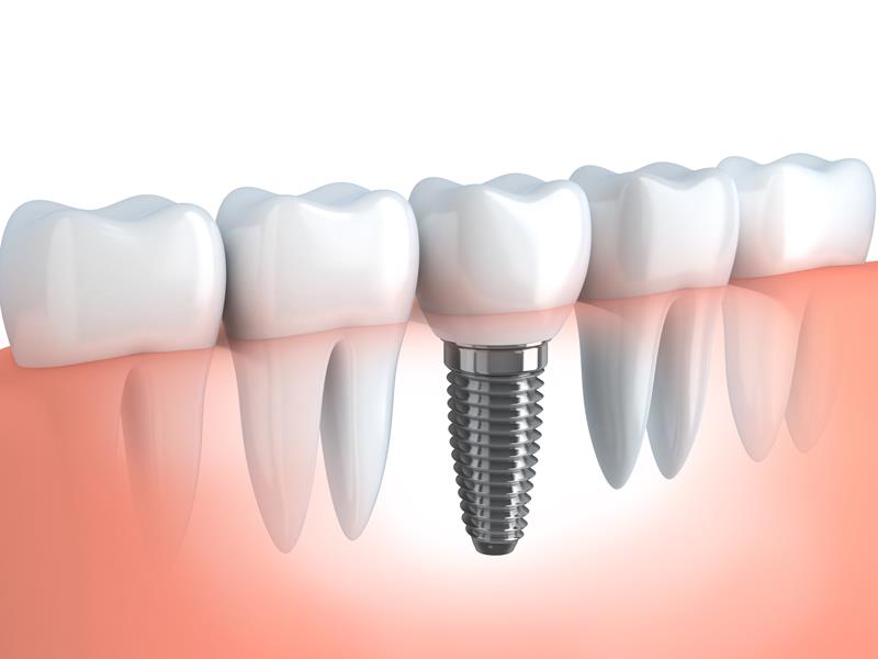 Dental Implants Crescent City, CA