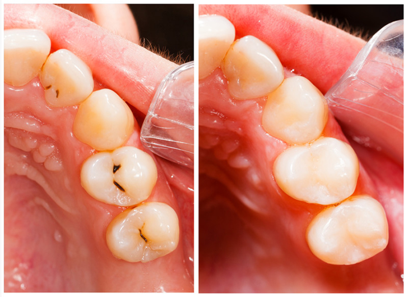 Fillings Crescent City, CA