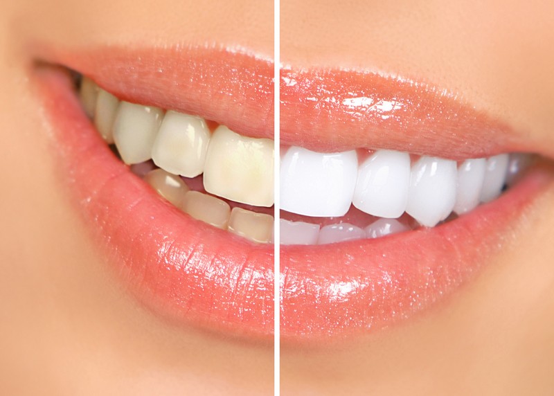 Teeth Whitening Crescent City, CA